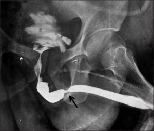 تنگی مجرای ادراری