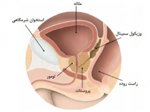 سرطان پروستات