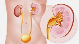 سنگ شکنی درون اندامی (TUL)