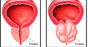 بزرگی خوش خیم پروستات