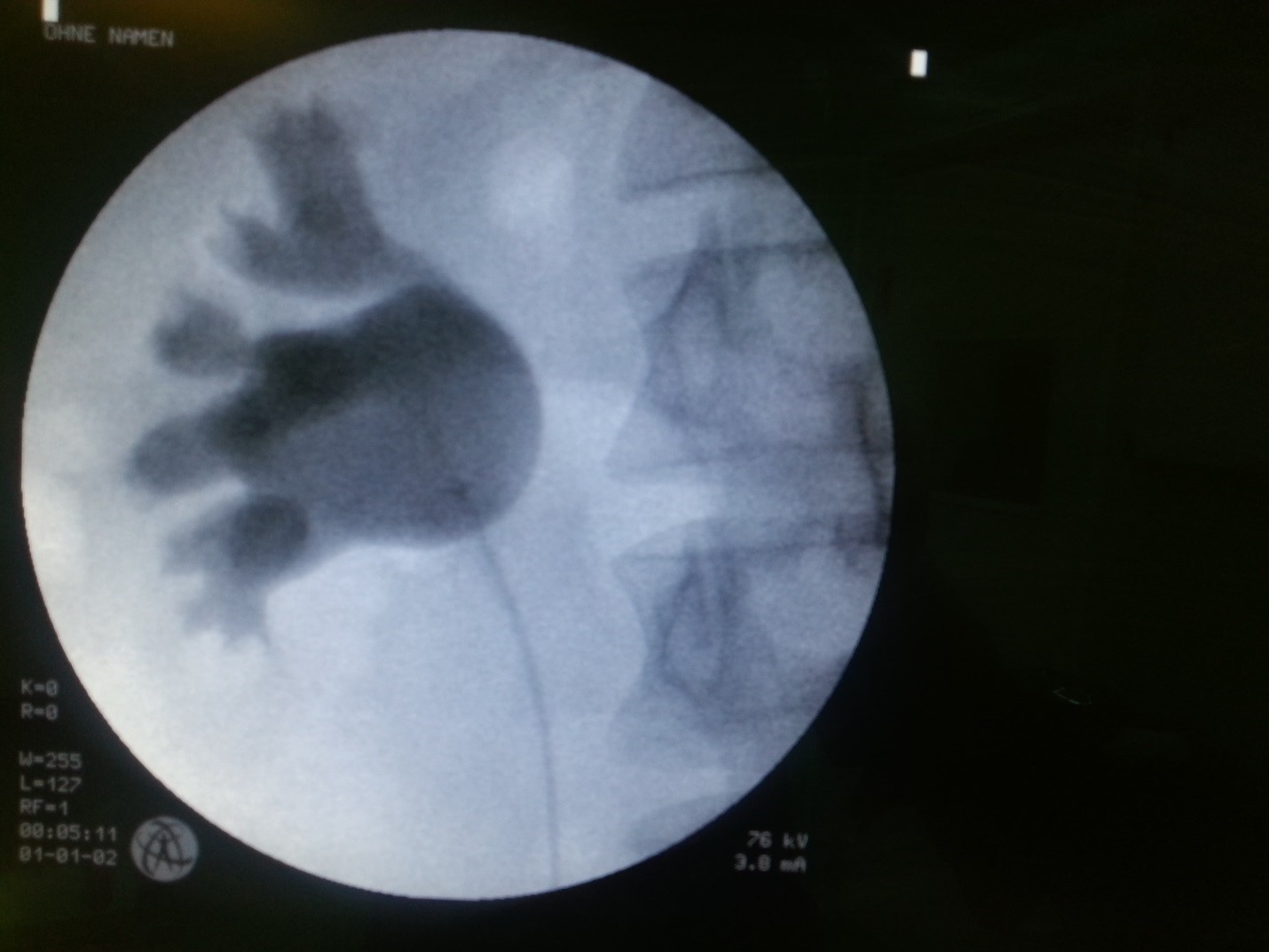 خروج سنگ کلیه PCNL