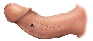 کجی آلت تناسلی