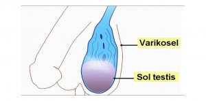 عمل واریکوسل
