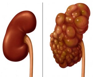 درمان کیست کلیه