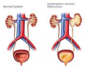 تنگی محل اتصال حالب به لگنچه