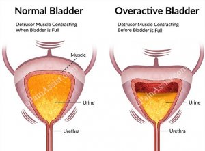 بی اختیاری ادراری