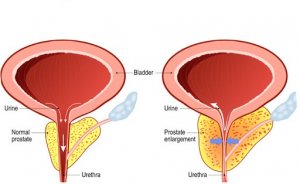 بزرگی پروستات