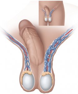 نحوه انجام جراحی واریکوسل به روش میکروسکوپی