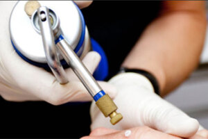 زگیل تناسلی