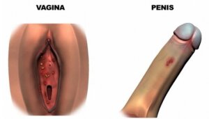 زگیل آلت تناسلی