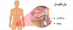 بزرگ شدن بیضه بعد از عمل واریکوسل