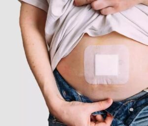 ورم بعد از جراحی فتق