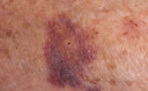 خونمردگی روی آلت تناسلی