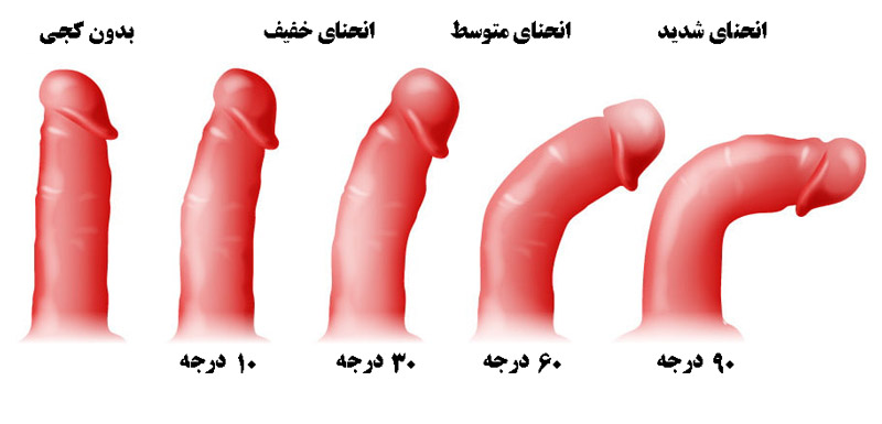 کجی آلت تناسلی به سمت پایین