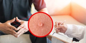 انتقال زگیل تناسلی - دکتر کیوان آقامحمدپور