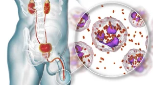 سوزاک - دکتر کیوان آقامحمدپور