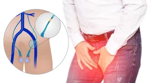 آمبولیزاسیون واریکوسل - دکتر کیوان آقامحمدپور