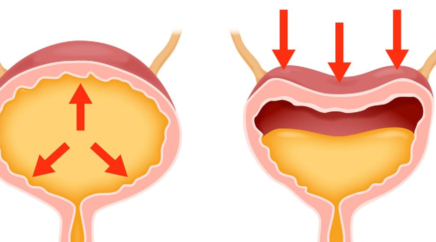 پیشگیری از بی‌اختیاری ادرار در افراد چاق