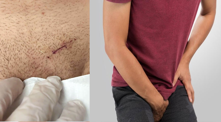 رابطه جنسی زودهنگام بعد از عمل واریکوسل خطرناک است؟