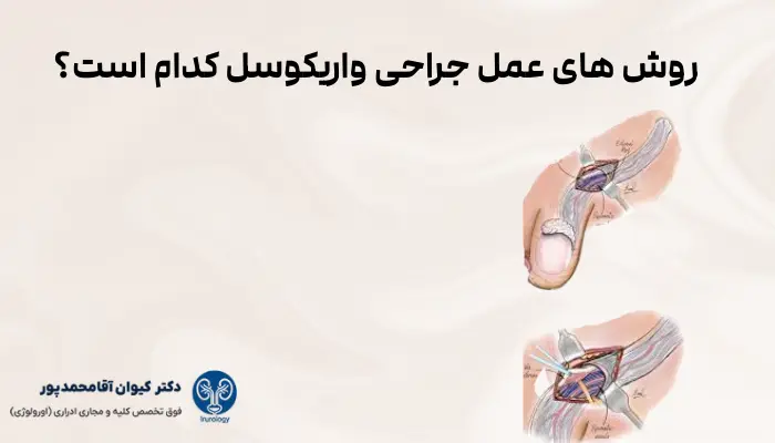 روش های عمل جراحی واریکوسل کدام است؟