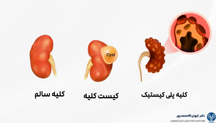 کلیه پلی کیستیک و کیست کلیه